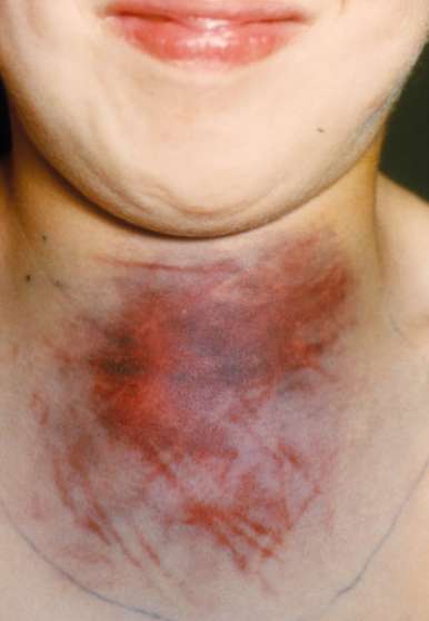 hemofilie-priznaky-projevy-symptomy-4