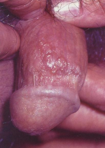 herpes-simplex-genitalis-opar-priznaky-projevy-symptomy-2
