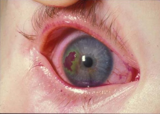 herpes-simplex-ocni-rohovka