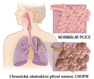 jak-se-projevuje-chronicka-obstrukcni-plicni-nemoc-CHOPN-priznaky-projevy-symptomy