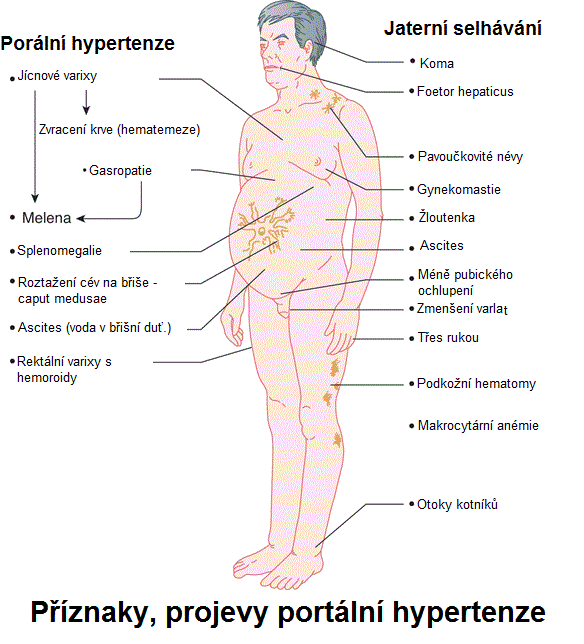 portální hypertenze příznaky