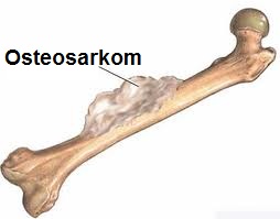 jak-se-projevuje-sarkom-kosti-osteosarkom-priznaky-projevy-symptomy