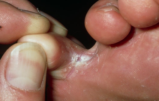jak-se-projevuje-tinea-pedis-plisen-nohou-priznaky-projevy-symptomy-3