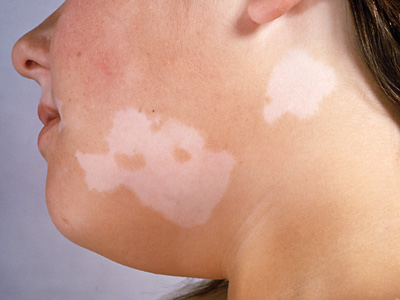 jak-se-projevuje-vitiligo-priznaky-projevy-symptomy-2