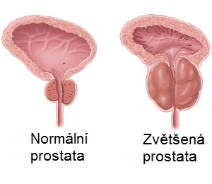 jak-se-projevuje-zvetseni-prostaty-hypertrofie-priznaky-projevy-symptomy-2
