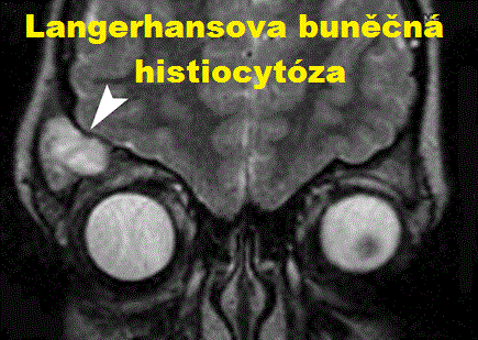 langerhansova-bunecna-histiocytoza-lch-priznaky-projevy-symptomy-19