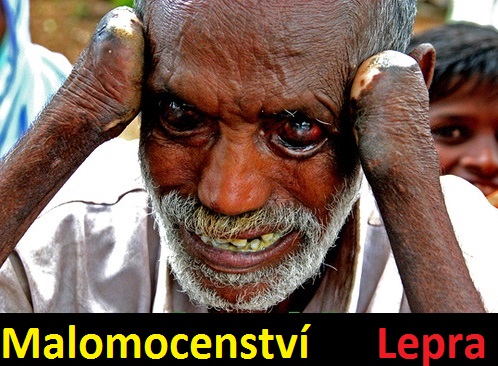 lepra-malomocenstvi-priznaky-projevy-symptomy-88