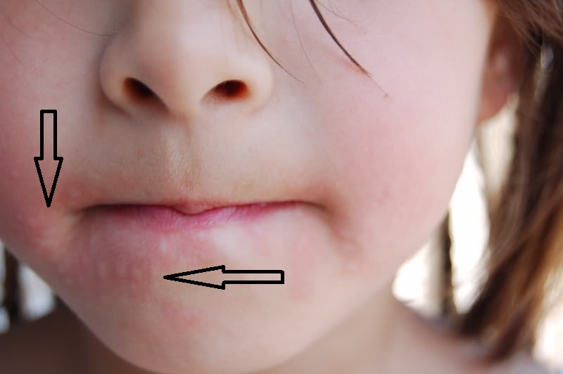 oralni-alergicky-syndrom-priznaky-projevy-symptomy-2