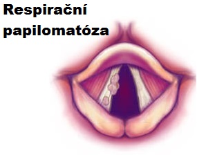 respiracni-papilomatoza-priznaky-projevy-symptomy-0 copy