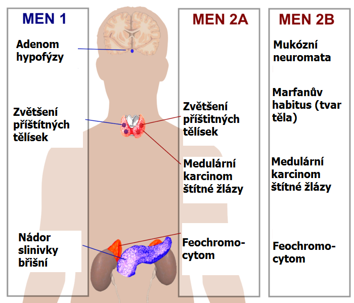 syndrom-mnohocetne-endokrinni-neoplazie-men-1-wermeruv-syndrom-priznaky-projevy-symptomy