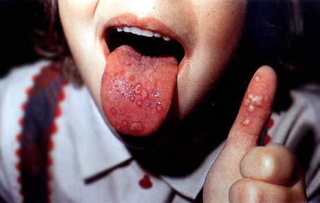 syndrom-ruka-noha-usta-priznaky-projevy-symptomy-2