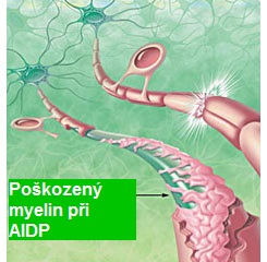aidp-akutni-zanetliva-demyelinizacni-polyradikuloneuritida-priznaky-projevy-symptomy-5