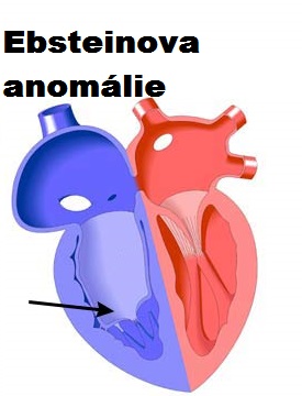 ebsteinova-anomalie-malformace-priznaky-projevy-symptomy-obrazek-fotografie-4