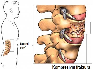 postmenopauzalni-osteoporoza-priznaky-projevy-symptomy-4-kompresivni-fraktura