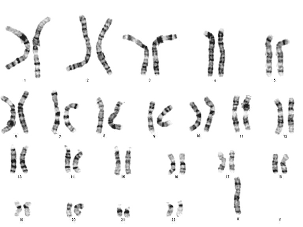 turneruv-syndrom-chromozomy