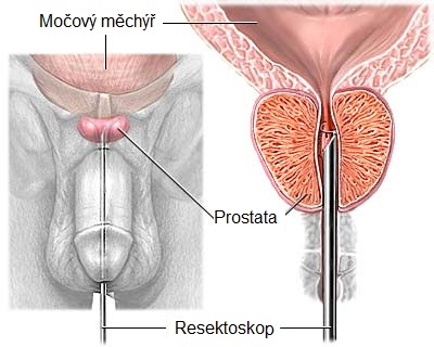 De ce sângerează adenomul de prostată